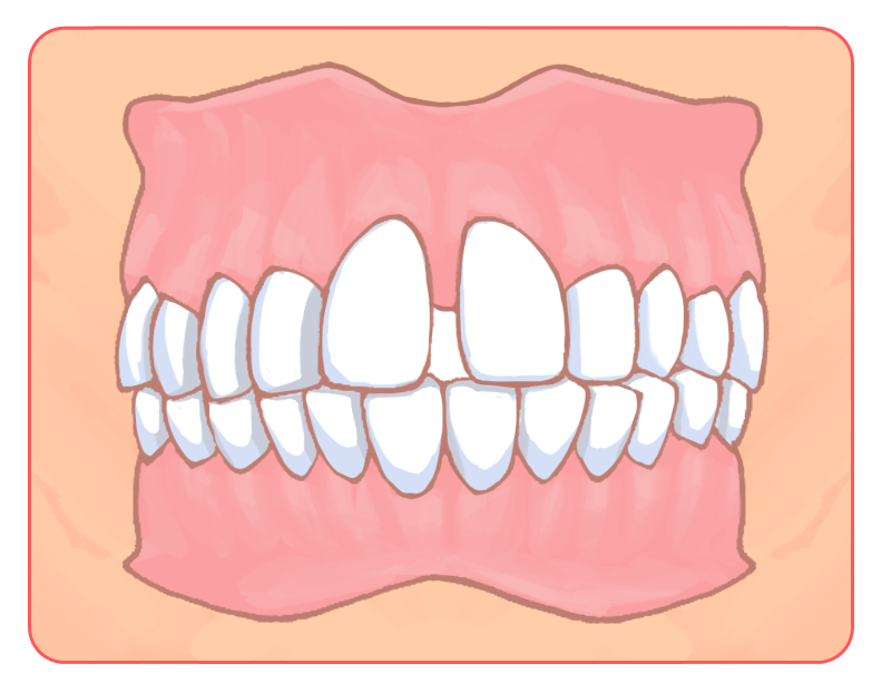 すきっ歯（空隙歯列）